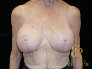 Breast Augmentation & Lift before and after, Patient 01