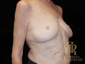 Breast Augmentation & Lift before and after, Patient 01
