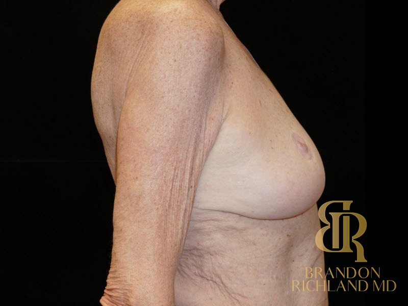Breast Augmentation & Lift Before photo, Patient 01