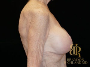 Breast Augmentation & Lift before and after, Patient 01