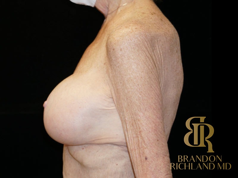 Breast Augmentation & Lift After photo, Patient 01