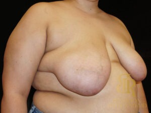 Breast Augmentation & Lift before and after, Patient 06