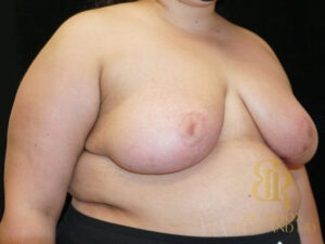 Breast Augmentation & Lift before and after, Patient 06