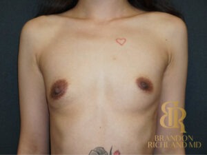 Breast Augmentation & Lift before and after, Patient 07