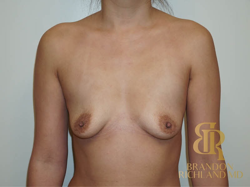 Breast Augmentation Before, Patient 01, view 1 — Dr. Brandon Richland, Newport Beach