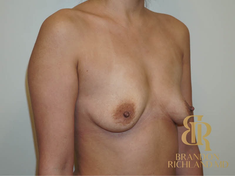 Breast Augmentation Before, Patient 01, view 2 — Dr. Brandon Richland, Newport Beach