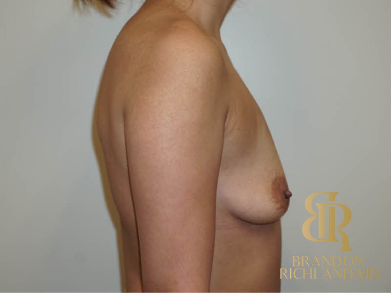 Breast Augmentation Before, Patient 01, view 3 — Dr. Brandon Richland, Newport Beach