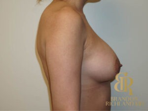 Breast Augmentation before and after, Patient 01 — Dr. Brandon Richland, Newport Beach