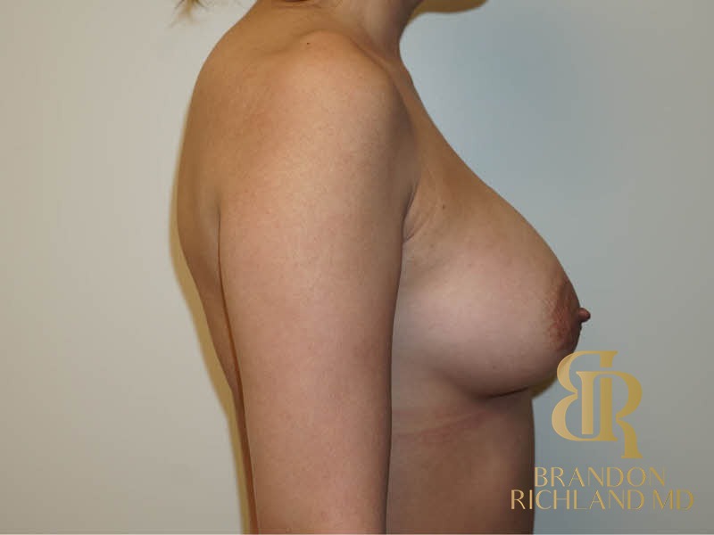 Breast Augmentation After, Patient 01, view 3 — Dr. Brandon Richland, Newport Beach