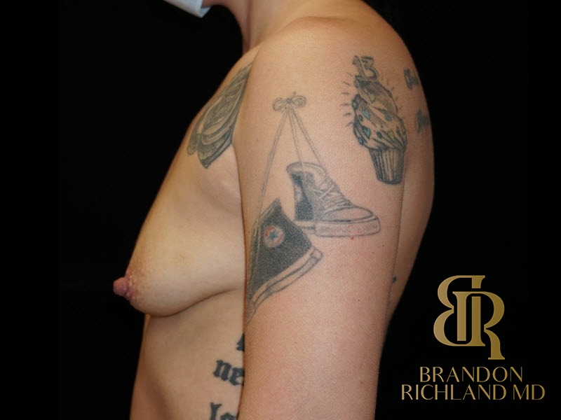 Breast Augmentation Before, Patient 02, view 5 — Dr. Brandon Richland, Newport Beach