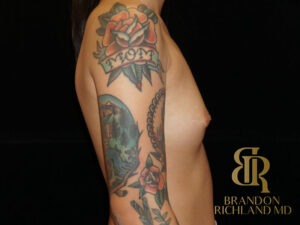 Breast Augmentation before and after, Patient 06 — Dr. Brandon Richland, Newport Beach