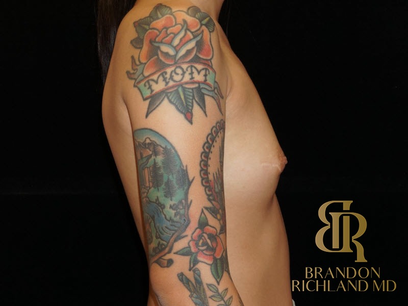 Breast Augmentation Before, Patient 06, view 3 — Dr. Brandon Richland, Newport Beach