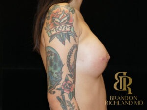 Breast Augmentation before and after, Patient 06 — Dr. Brandon Richland, Newport Beach