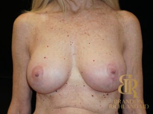 Breast Augmentation before and after, Patient 10 — Dr. Brandon Richland, Newport Beach