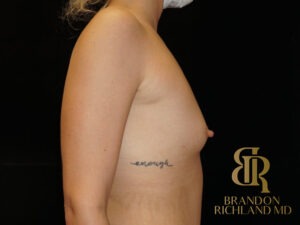 Breast Augmentation before and after, Patient 11 — Dr. Brandon Richland, Newport Beach
