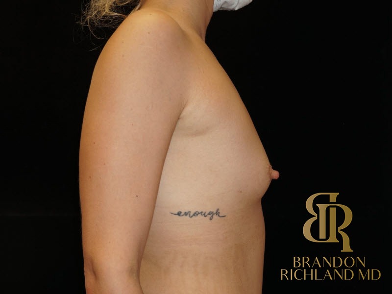 Breast Augmentation Before, Patient 11, view 3 — Dr. Brandon Richland, Newport Beach