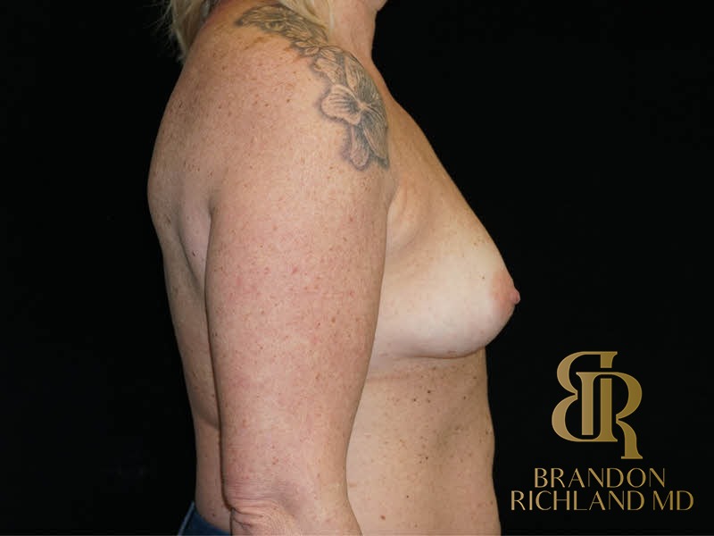 Breast Augmentation Before, Patient 14, view 3 — Dr. Brandon Richland, Newport Beach