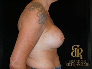 Breast Augmentation before and after, Patient 14 — Dr. Brandon Richland, Newport Beach