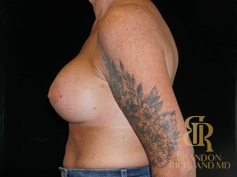 Breast Augmentation After, Patient 14, view 5 — Dr. Brandon Richland, Newport Beach
