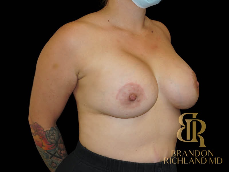 Breast Augmentation After, Patient 15, view 2 — Dr. Brandon Richland, Newport Beach