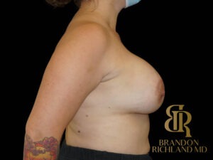 Breast Augmentation before and after, Patient 15 — Dr. Brandon Richland, Newport Beach