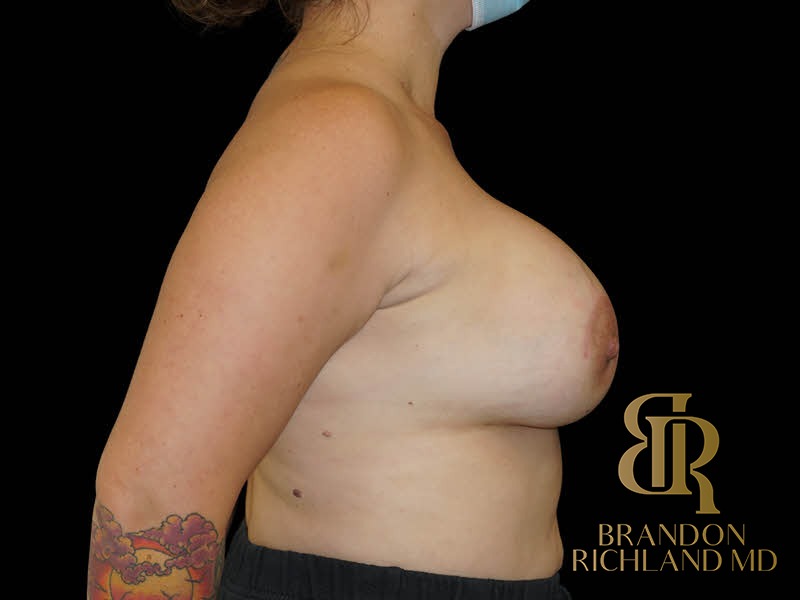 Breast Augmentation After, Patient 15, view 3 — Dr. Brandon Richland, Newport Beach