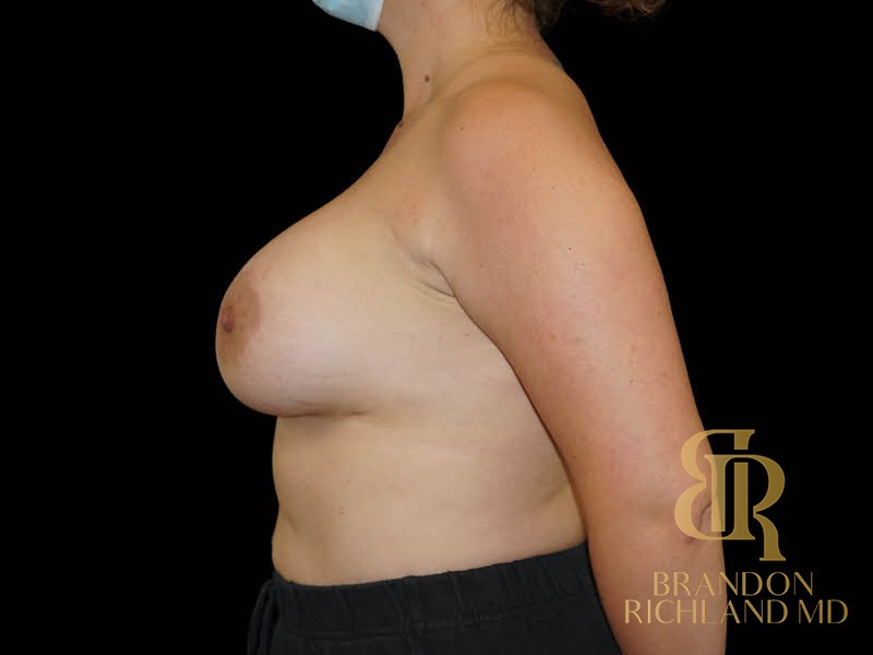 Breast Augmentation After, Patient 15, view 5 — Dr. Brandon Richland, Newport Beach