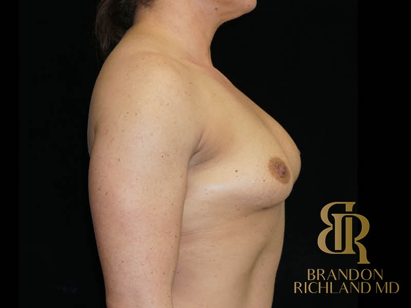 Breast Augmentation Before, Patient 16, view 3 — Dr. Brandon Richland, Newport Beach