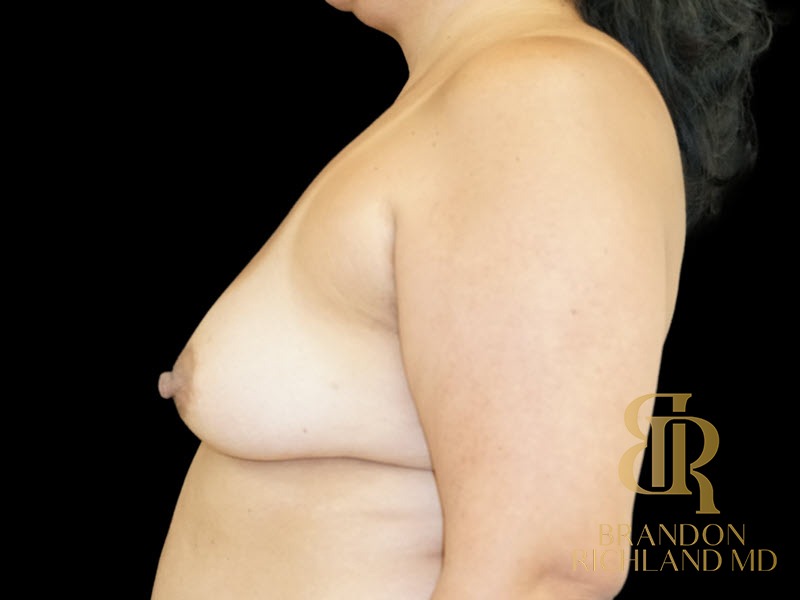 Breast Augmentation Before, Patient 18, view 5 — Dr. Brandon Richland, Newport Beach