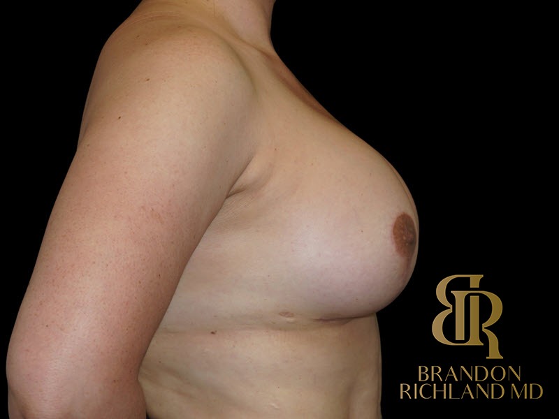 Breast Augmentation After, Patient 20, view 3 — Dr. Brandon Richland, Newport Beach