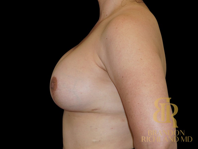 Breast Augmentation After, Patient 20, view 5 — Dr. Brandon Richland, Newport Beach