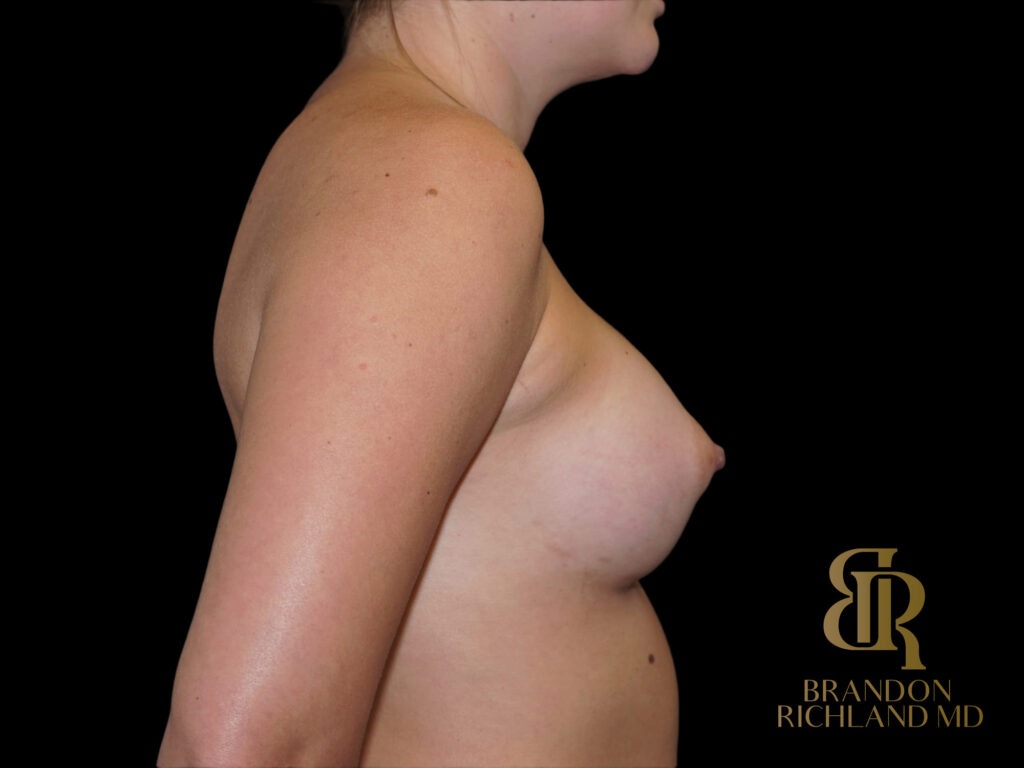 Breast Augmentation After, Patient 23, view 3 — Dr. Brandon Richland, Newport Beach