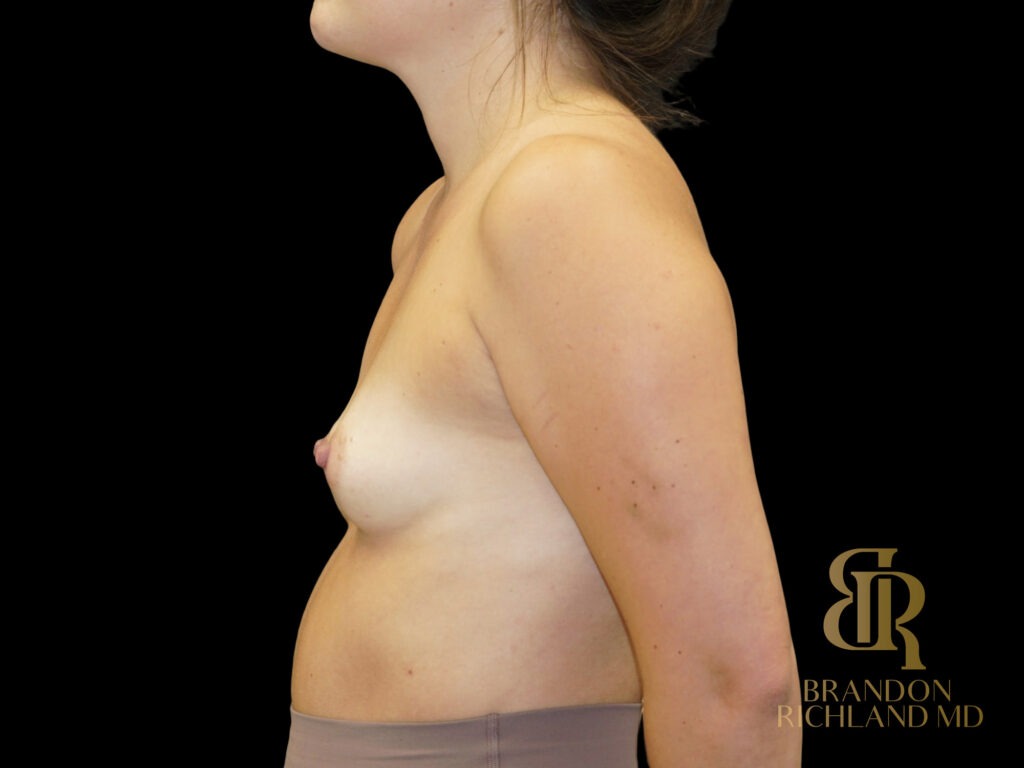 Breast Augmentation Before, Patient 23, view 5 — Dr. Brandon Richland, Newport Beach