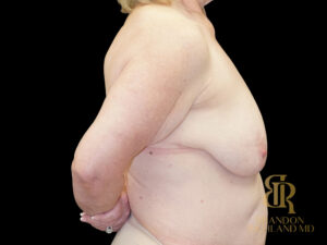Breast Augmentation before and after, Case #53862 — Dr. Brandon Richland, Newport Beach