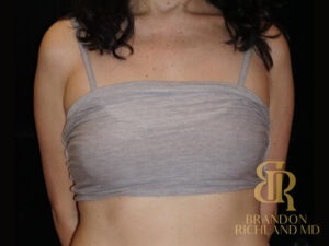 Breast Fat Transfer before and after, Patient 02 — Dr. Brandon Richland, Newport Beach