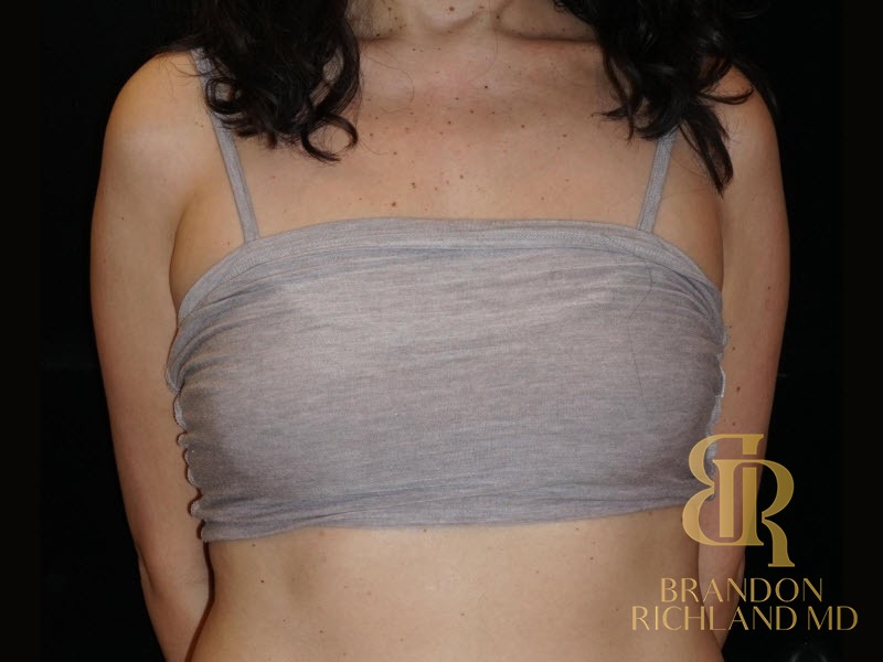Breast Fat Transfer Before photo, Patient 02
