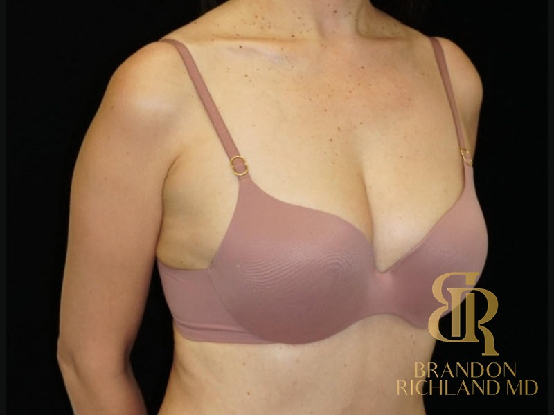 Breast Fat Transfer After photo, Patient 02