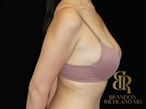 Breast Fat Transfer before and after, Patient 02 — Dr. Brandon Richland, Newport Beach
