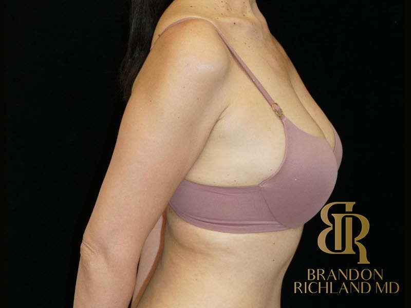 Breast Fat Transfer After photo, Patient 02