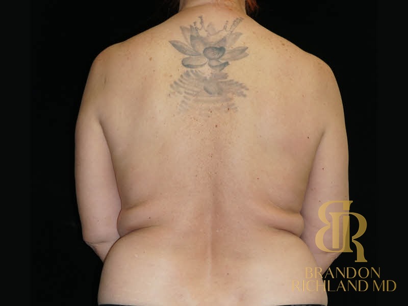 Breast Fat Transfer Before photo, Patient 04