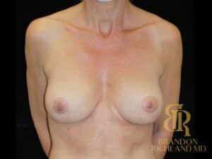 Breast Fat Transfer before and after, Patient 07 — Dr. Brandon Richland, Newport Beach