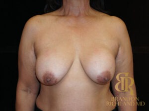 Breast Implant Removal before and after, Patient 02 — Dr. Brandon Richland, Newport Beach