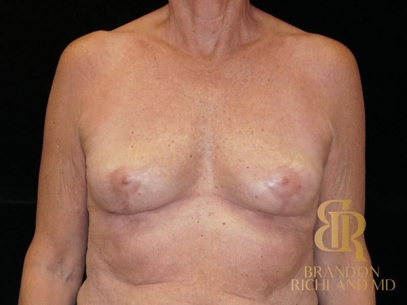 Breast Implant Removal After, Patient 04, view 1 — Dr. Brandon Richland, Newport Beach