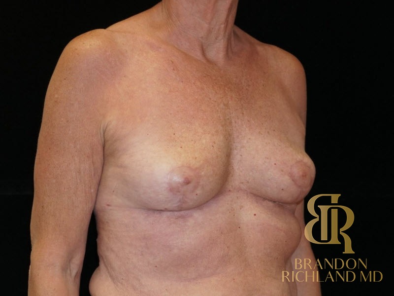 Breast Implant Removal After, Patient 04, view 2 — Dr. Brandon Richland, Newport Beach