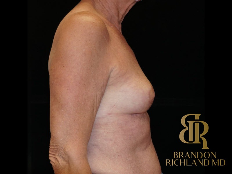 Breast Implant Removal After, Patient 04, view 3 — Dr. Brandon Richland, Newport Beach
