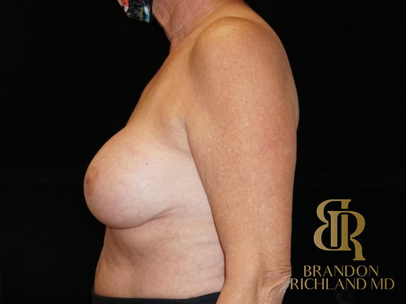Breast Implant Removal Before, Patient 04, view 5 — Dr. Brandon Richland, Newport Beach