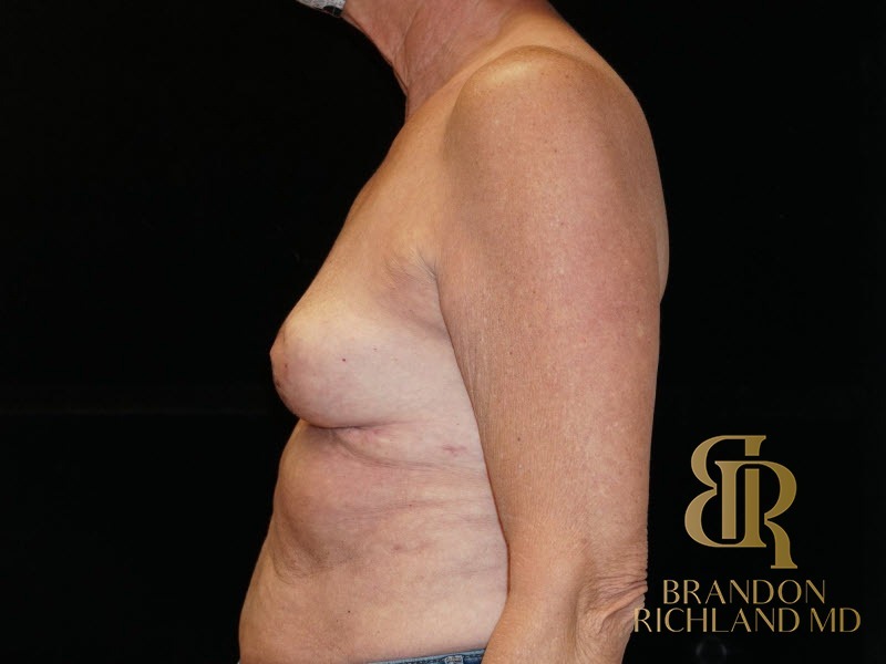 Breast Implant Removal After, Patient 04, view 5 — Dr. Brandon Richland, Newport Beach