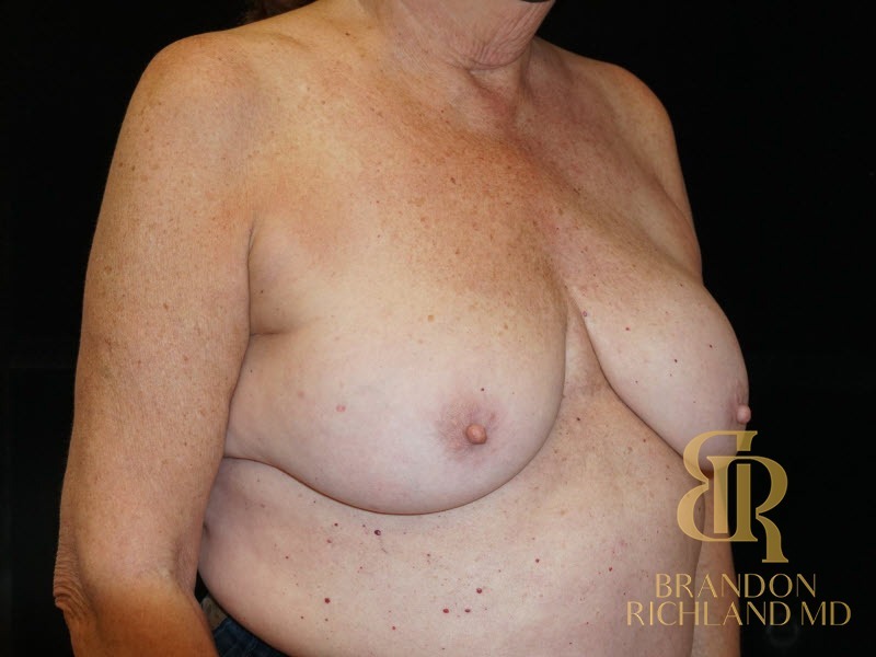 Breast Implant Removal Before, Patient 05, view 2 — Dr. Brandon Richland, Newport Beach