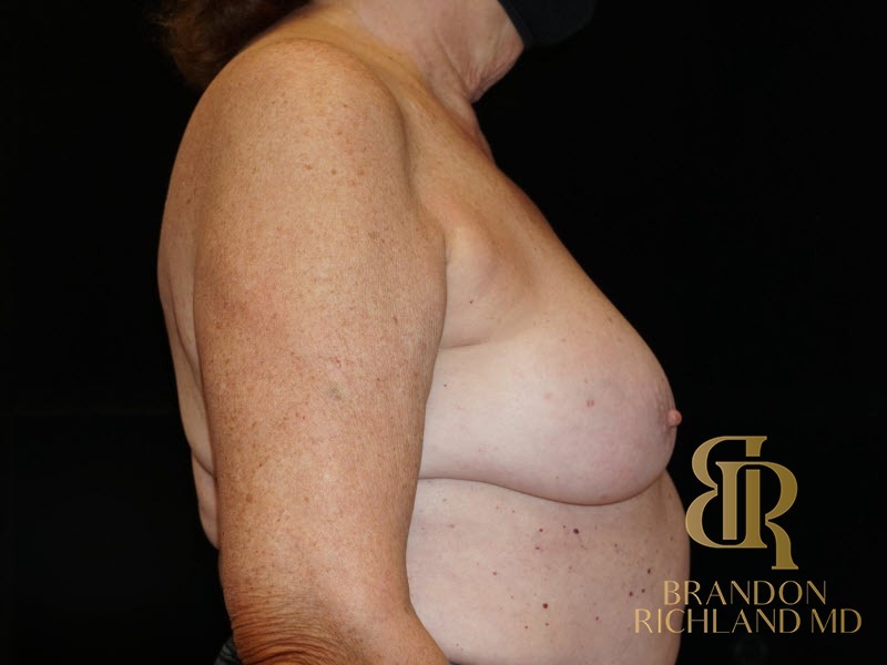 Breast Implant Removal Before, Patient 05, view 3 — Dr. Brandon Richland, Newport Beach