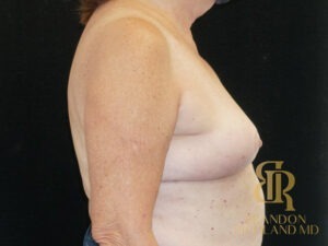 Breast Implant Removal before and after, Patient 05 — Dr. Brandon Richland, Newport Beach
